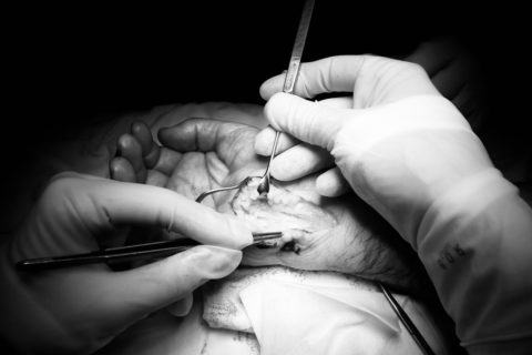 SINDROMUL DE CANAL GUYON