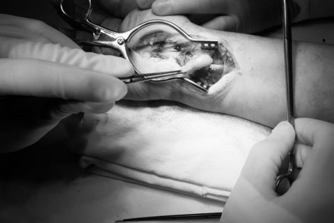 Tumori-nervi-periferici