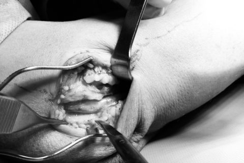 sindrom-tunel-cubital